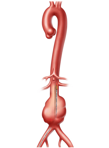 Image: The Visions PV .035 digital IVUS catheter (Photo courtesy of Volcano).